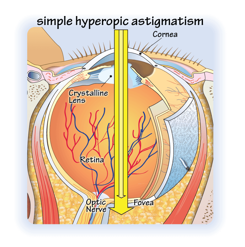 simple-hyperopic-astigmatism-opticianworks-online-optician-training