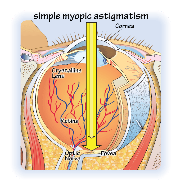 simple-myopic-astigmatism-opticianworks-online-optician-training